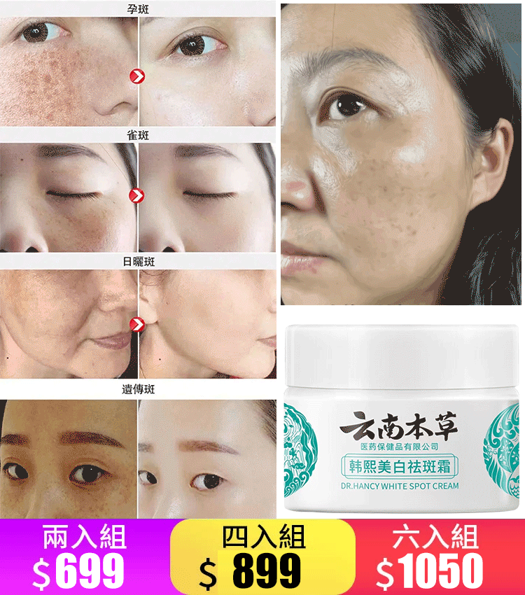 色斑、雀斑、老年斑,滿臉斑怎麼辦?用它,一抹淡斑!!雲南本草美白祛斑霜。 色斑、雀斑、老年斑,滿臉斑怎麼辦?用它,一抹淡斑!!雲南本草美白祛斑霜。